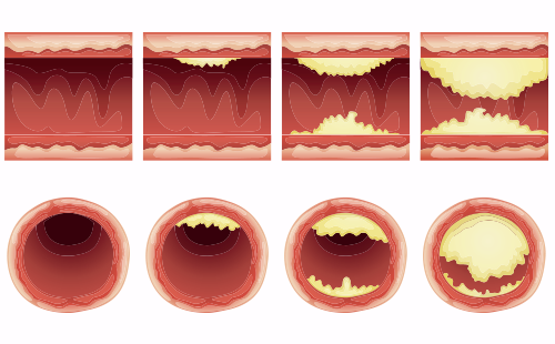 動(dòng)脈硬化檢測(cè)儀
